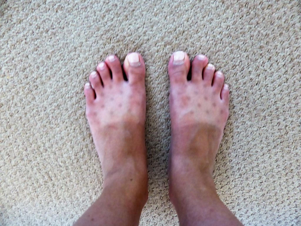 My spotty feet